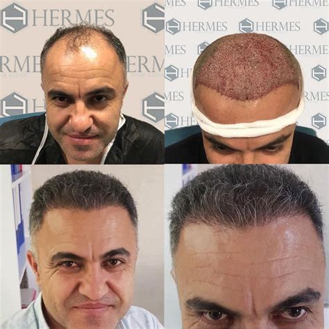 hermes hair transplant istanbul